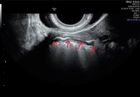  HYFOSY test de perméabilité des trompes AMP Grenoble Belledonne